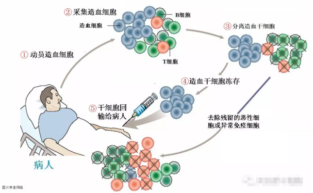 干細(xì)胞治療系統(tǒng)性硬化病，安全且有效