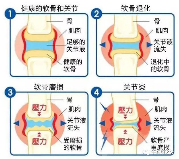 干細胞療法注射關(guān)節(jié)腔或?qū)⒊蔀橹委熽P(guān)節(jié)炎的最