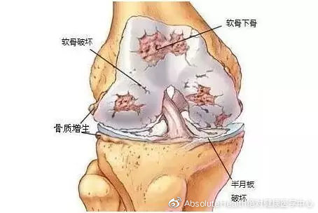 成功案例 | 再生醫(yī)學(xué)療法是如何治療關(guān)節(jié)炎的？