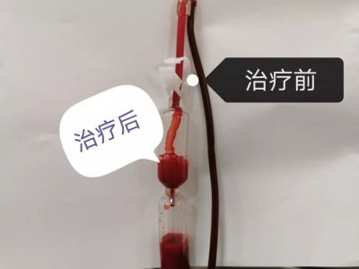 三氧自血療法：安全、有效的多功能治療方法