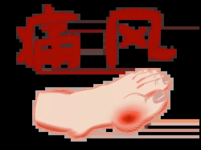 干細(xì)胞療法治療痛風(fēng)