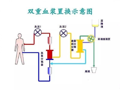精準(zhǔn)凈化，煥活健康：DFPP雙重血漿凈化技術(shù)
